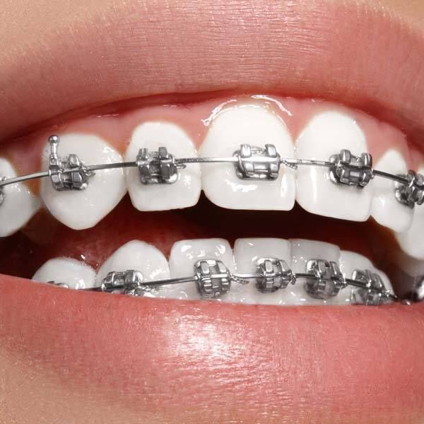 Paciente con sonrisa perfecta tras ortodoncia y estética dental