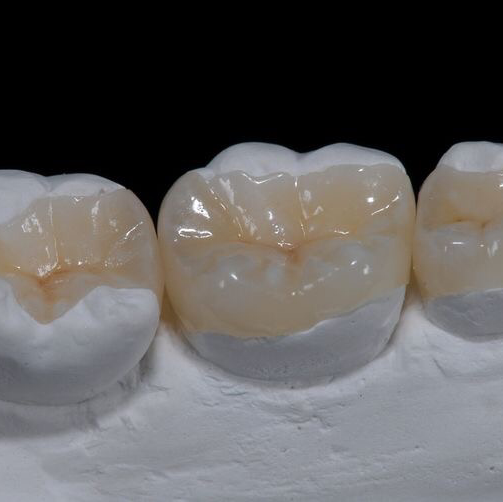 Trabajo de corona dental realizado en el consultorio